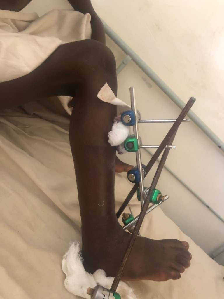 operatiebeenIMG_4388